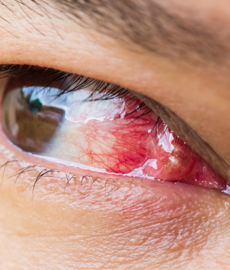 Corneal surgery