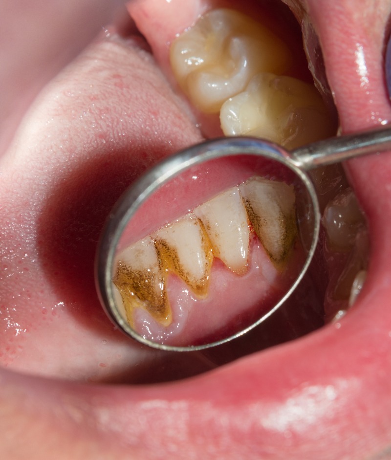 Dental Restorations