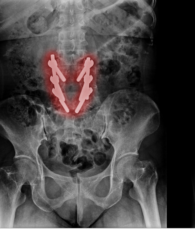 Laminectomy